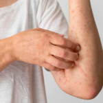 Herpes Zoster Causes, Symptoms Treatment