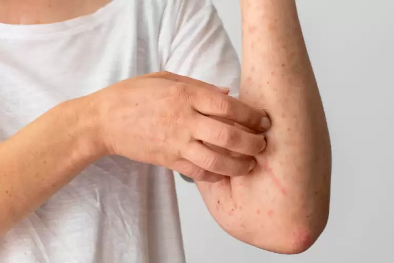 Herpes Zoster Causes, Symptoms Treatment