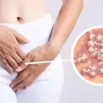 Herpes-and-sex