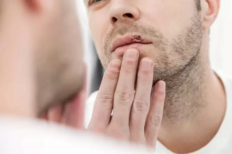 Long-Term Effects of Herpes