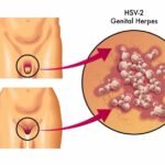 What is Herpes HSV-2