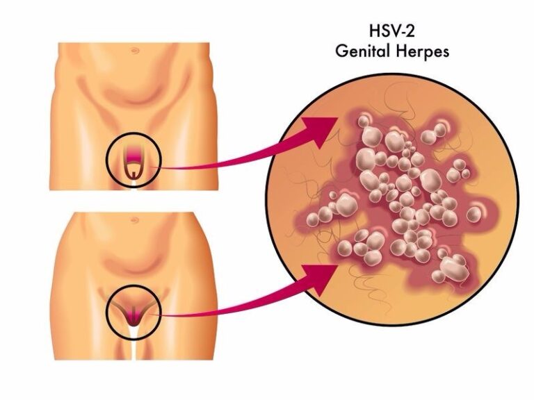 What is Herpes HSV-2