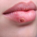 herpes hsv-1-what-is
