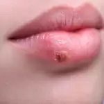 herpes hsv-1-what-is