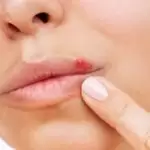 Can Herpes Heal on Its Own