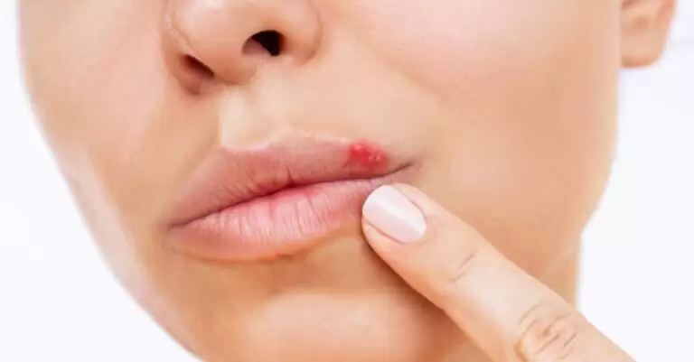 Can Herpes Heal on Its Own
