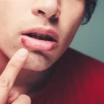 How Does Herpes Manifest Itself