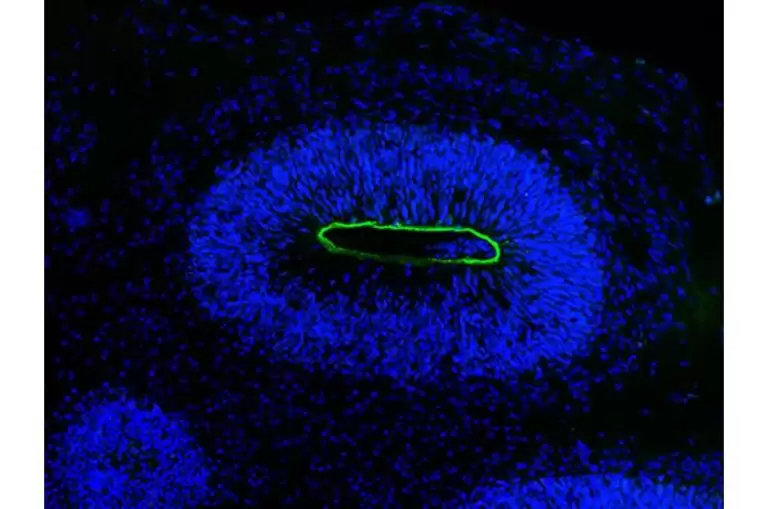 studying-herpes-enceph-1