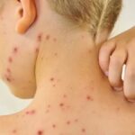 What's the relationship between Herpes Zoster and Chickenpox
