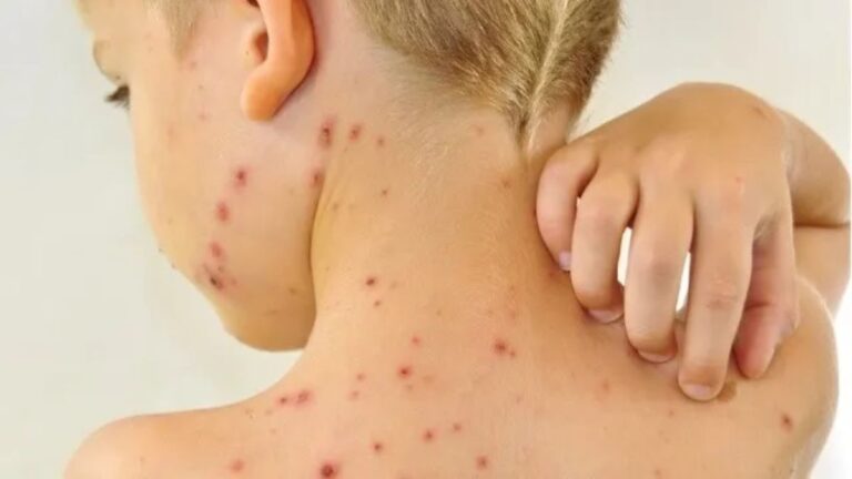 What's the relationship between Herpes Zoster and Chickenpox