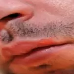 Do I need to shave if I have herpes