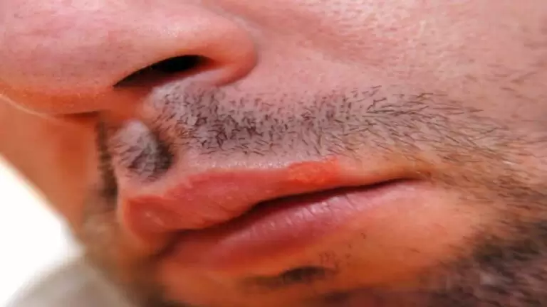 Do I need to shave if I have herpes