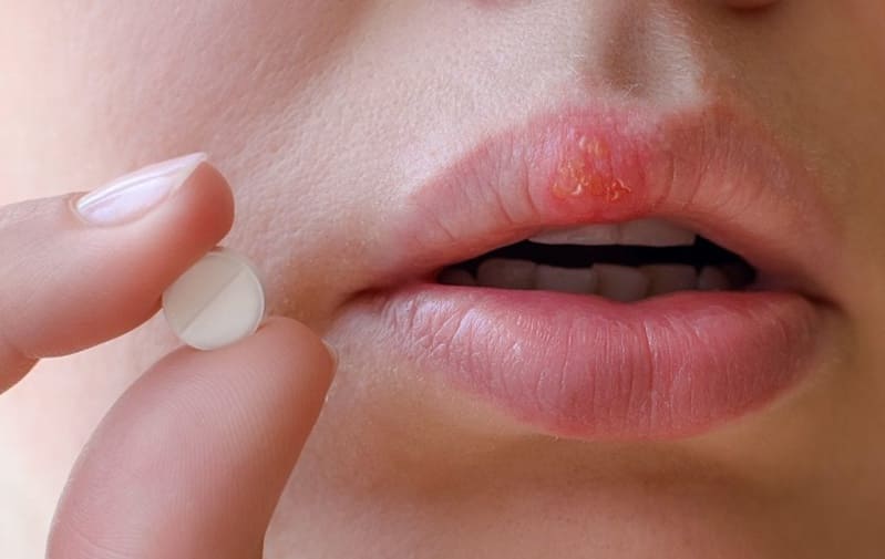 Hidden Side Effects of Antivirals for Herpes